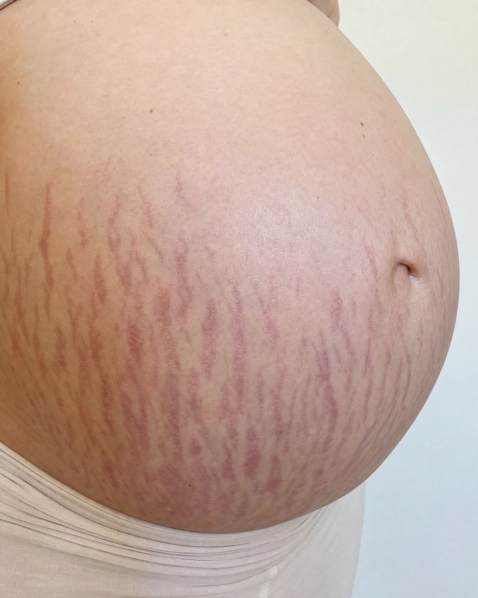 pregnant_belly_stretch_marks.jpg